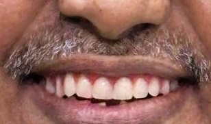 After smile makeover