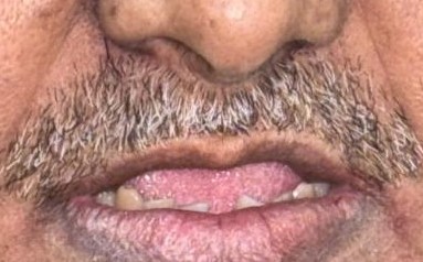 Before smile makeover