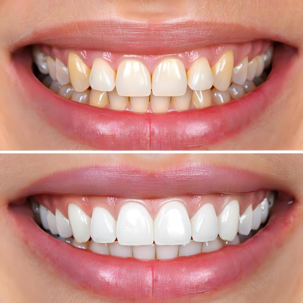 Professional teeth whitening treatment